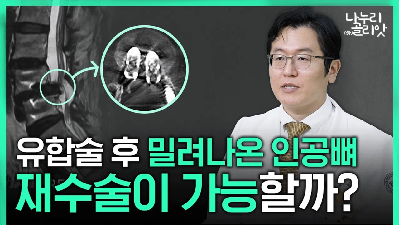 [나누리골리앗] 척추유합술 후에 재발한 통증???? 튀어나온 인공뼈, 재수술 가능? 불가능? (CT, MRI 수술 전후)